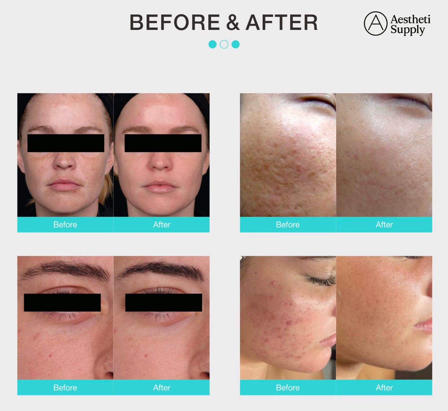 Lavandula™ Thulium Laser – Advanced Skin Brightening & Rejuvenation Technology